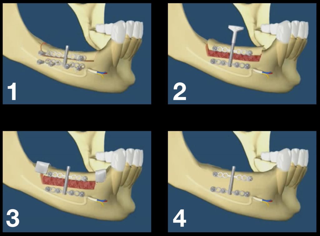 Distraction Osteogenesis Procedural Steps