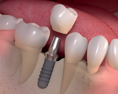 Dental implant screw